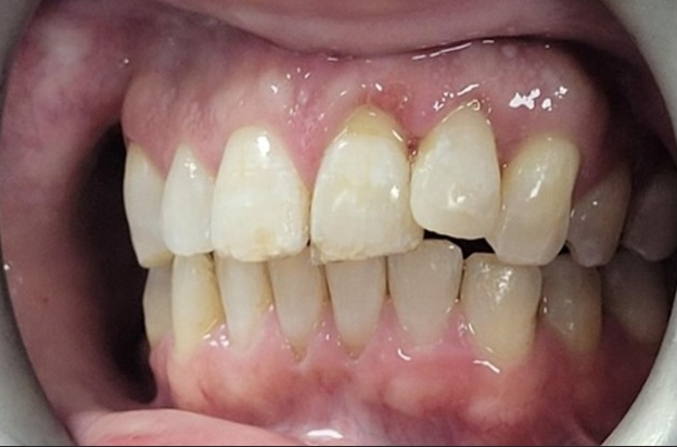 Dental trauma management - 6 month review case 1